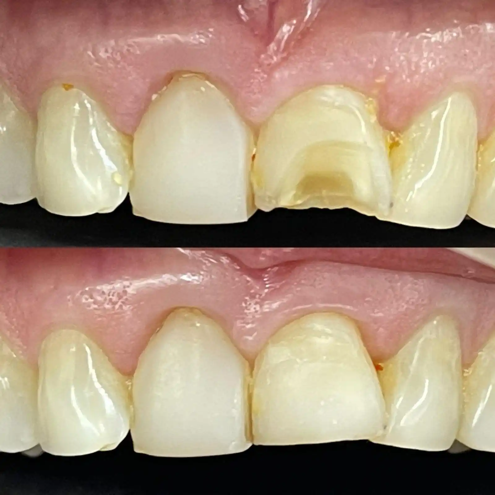 Before and after photographs of a chipped upper front tooth rebuilt with a tooth coloured composite filling