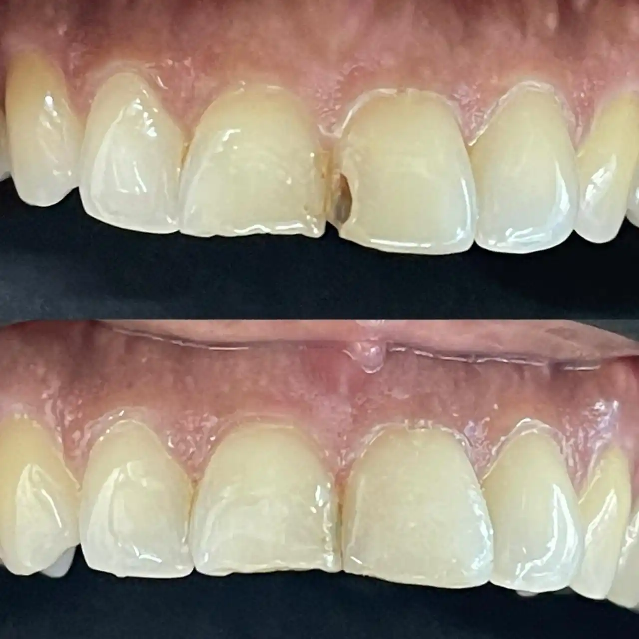 Before and after photographs of a worn and chipped front tooth edge restored with composite bonding