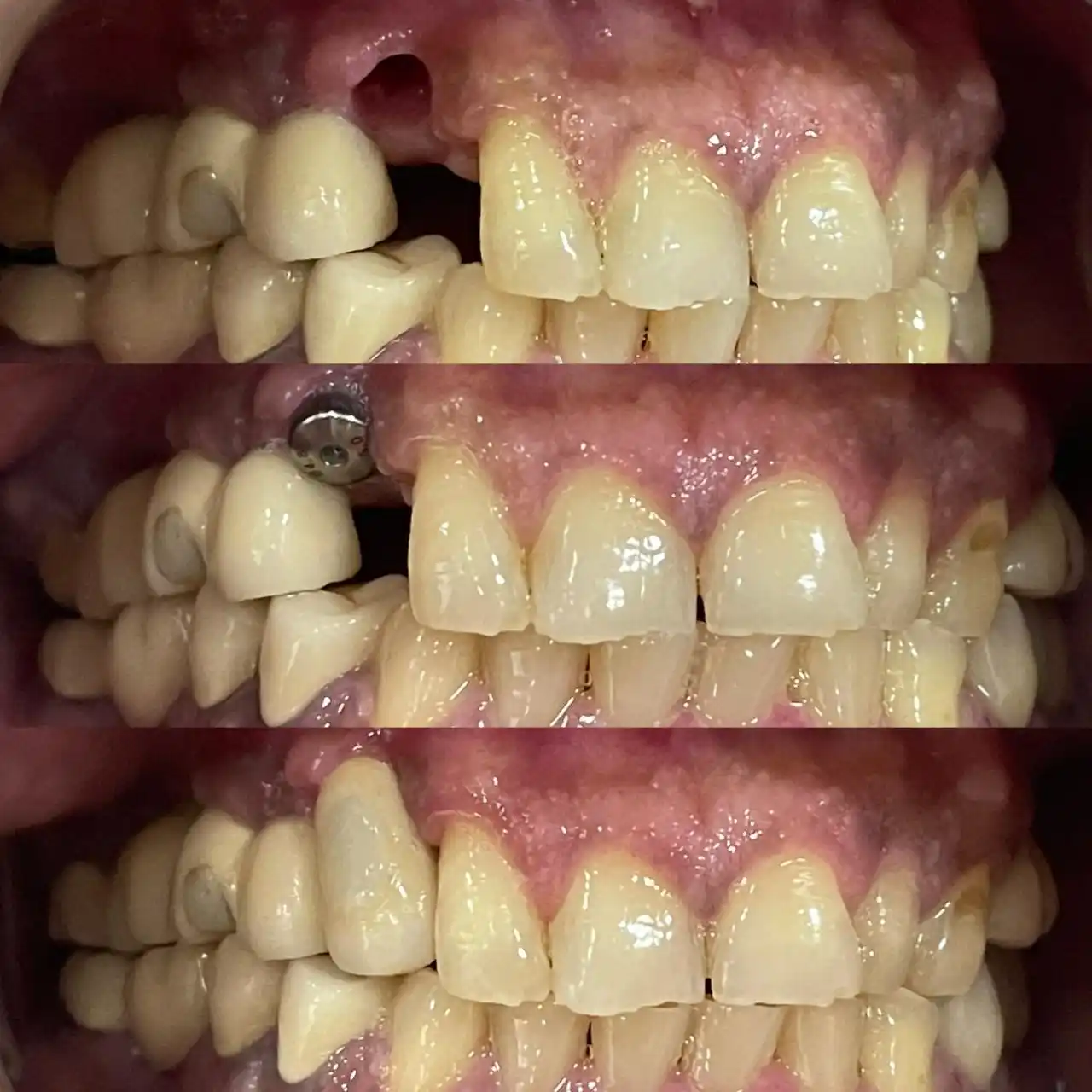 Three stage photographs of a single tooth dental implant showing the gap, the healing implant post, and the final crown in place