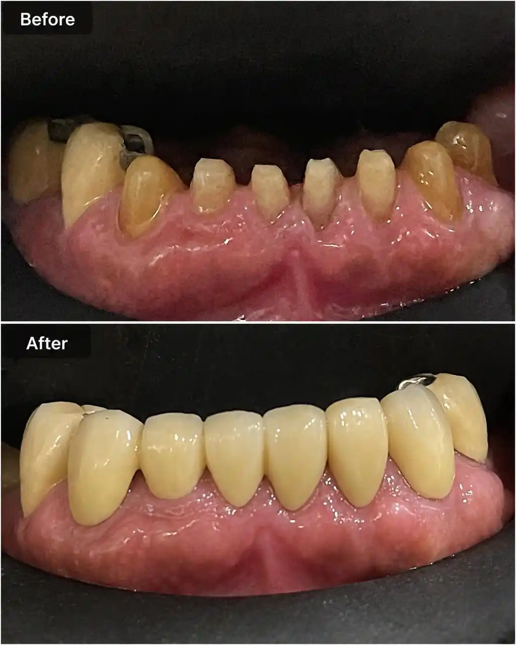 Before and after photographs of worn down lower teeth restored with a full arch ceramic bridge
