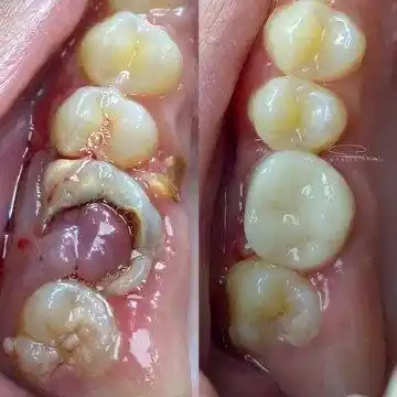 Before and after photographs of a decayed back molar treated with root canal treatment and restored with a crown