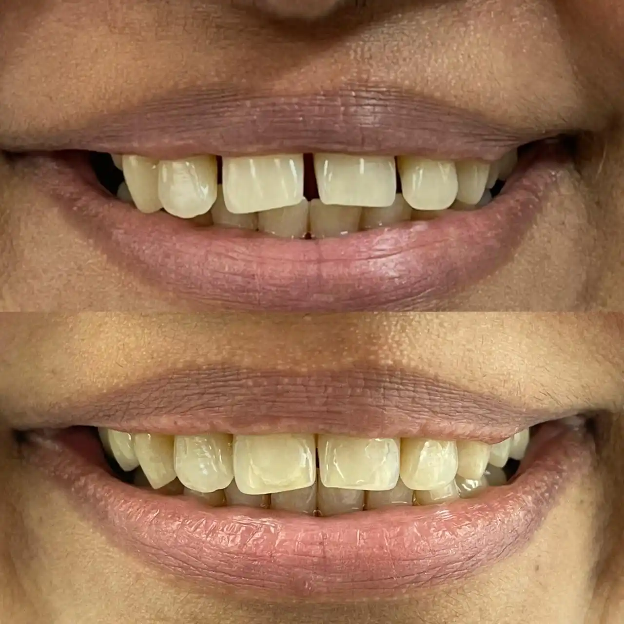 Before and after photographs of a smile makeover closing a gap between the upper front teeth, treated at Dr. Bhavna Dedhia's dental clinic in Ghatkopar East