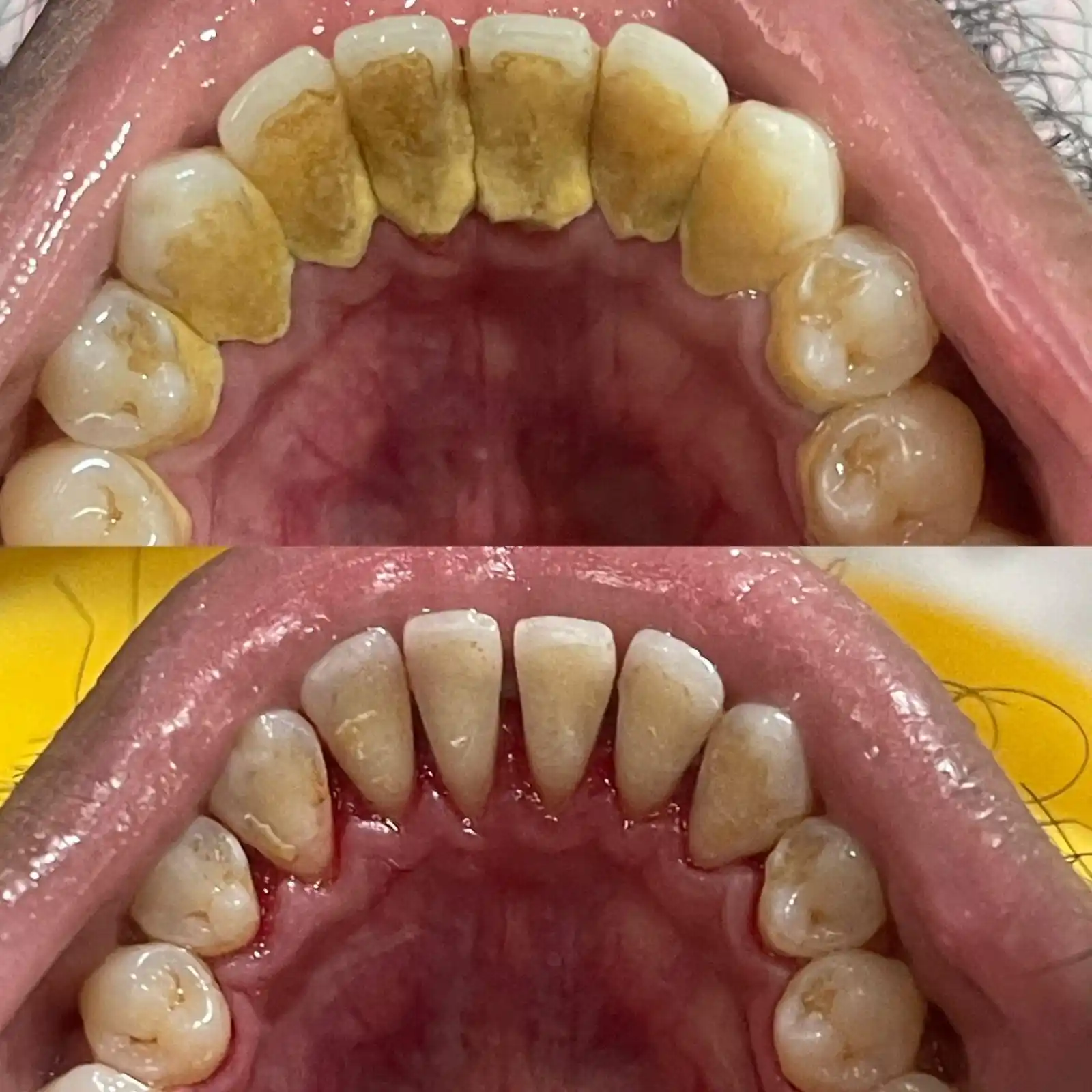 Before and after photographs of ultrasonic scaling and polishing removing heavy tartar deposits from the inner surfaces of the teeth